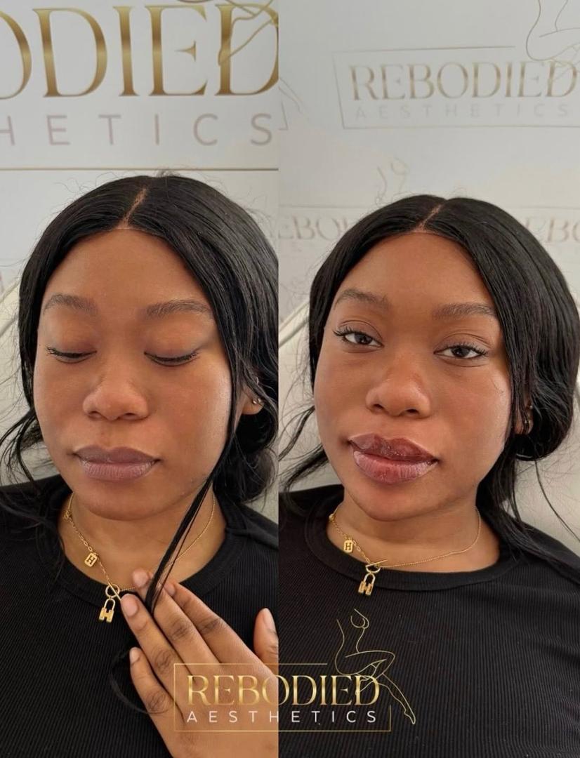 Before and after facial refinement result